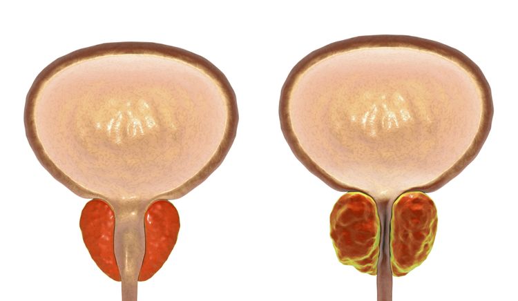 Normálna vs. zväčšená prostata